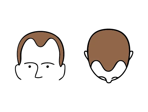 Hair loss along the hairline