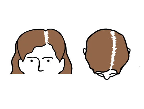 Hair loss at the top